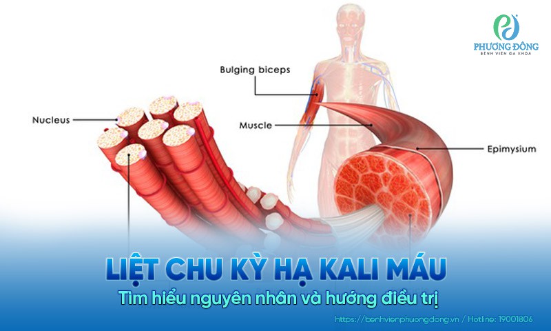 Liệt chu kỳ hạ kali máu: Tìm hiểu nguyên nhân và hướng điều trị