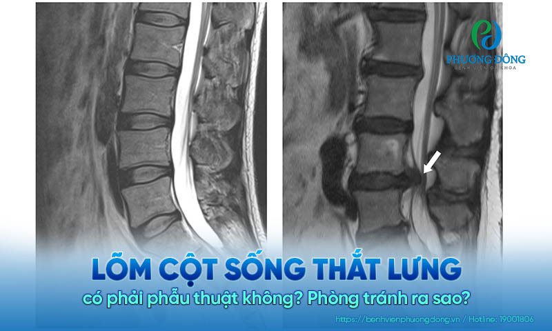 Lõm cột sống thắt lưng có phải phẫu thuật không? Phòng tránh ra sao?