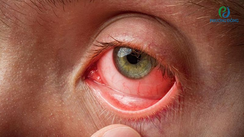 Viêm kết mạc là một trong những nguyên nhân khiến lòng trắng mắt bị đỏ
