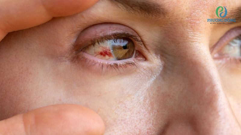 Tròng trắng mắt chuyển đỏ do xuất huyết dưới kết mạc