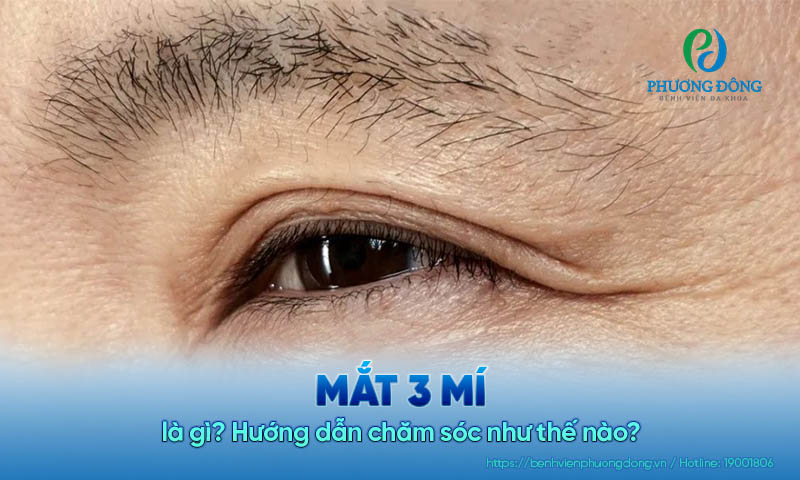 Mắt 3 mí là gì? Hướng dẫn chăm sóc như thế nào?
