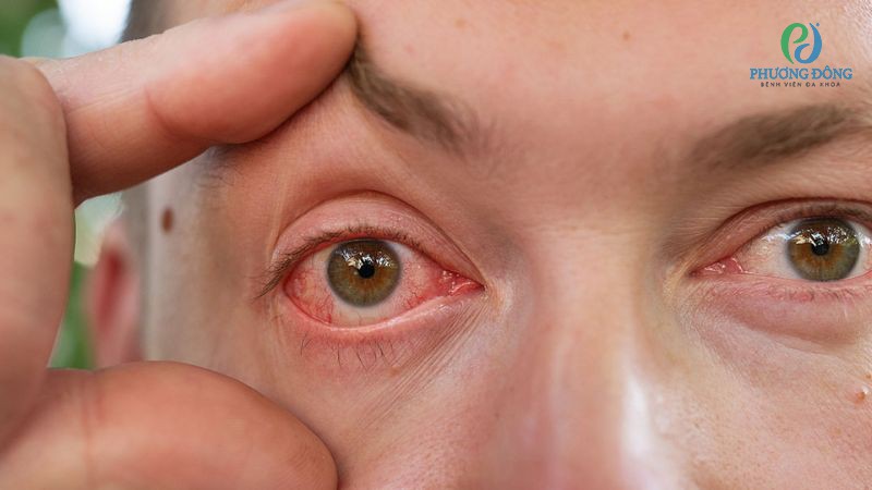 Viêm mống mắt xảy ra do bệnh u hạt, viêm khớp dạng thấp hoặc nhiễm trùng