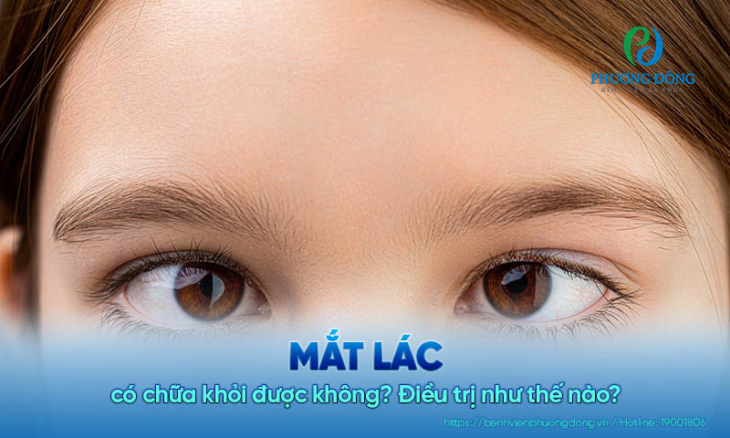 Mắt lác có chữa khỏi được không? Điều trị như thế nào?