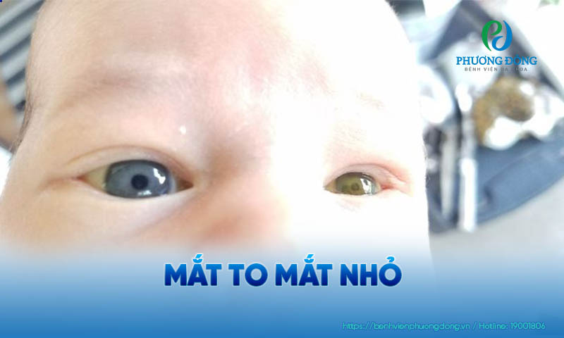 Hai mắt không cân đối có thể nhận biết bằng mắt thường