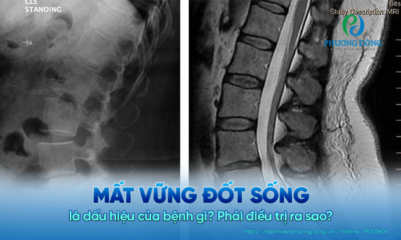Mất vững đốt sống là dấu hiệu của bệnh gì? Phải điều trị ra sao?