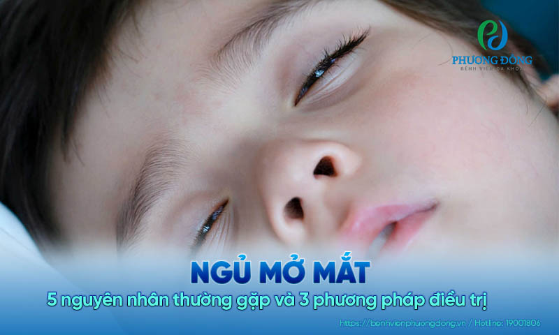 Ngủ mở mắt: 5 nguyên nhân thường gặp và 3 phương pháp điều trị