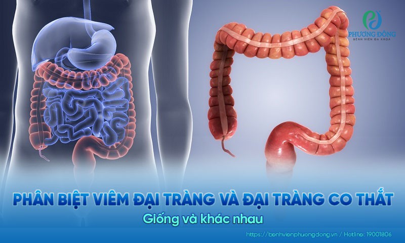 Phân biệt viêm đại tràng và đại tràng co thắt: Giống và khác nhau