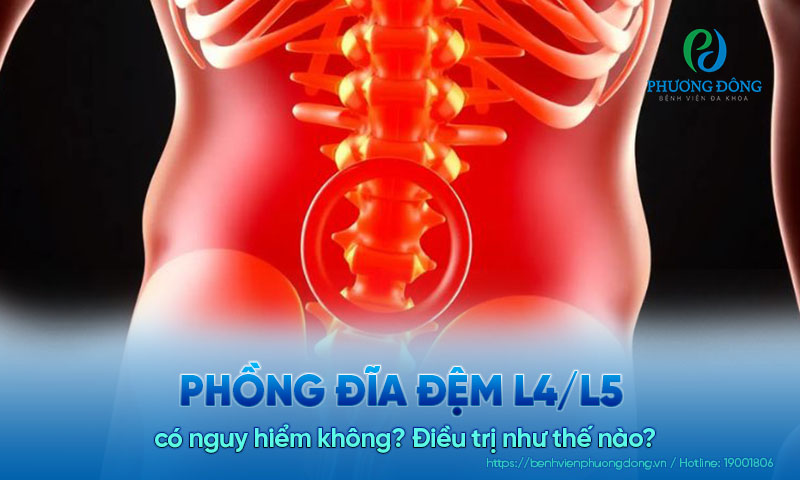 Phồng đĩa đệm L4/L5 có nguy hiểm không? Điều trị như thế nào?