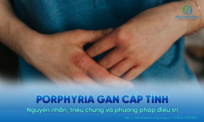 Porphyria gan cấp tính: Nguyên nhân, triệu chứng và phương pháp điều trị