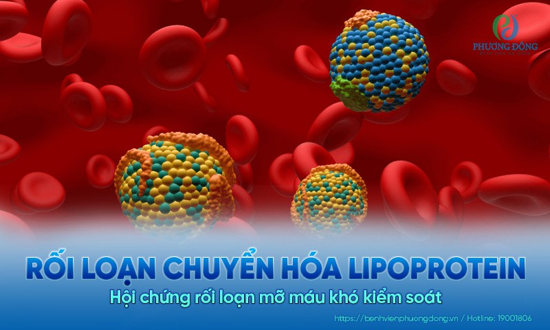 Rối loạn chuyển hóa lipoprotein – Hội chứng rối loạn mỡ máu phức tạp