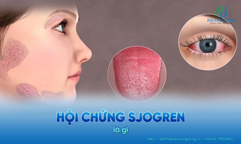 Hội chứng Sjogren: Dấu hiệu, nguyên nhân và hướng điều trị