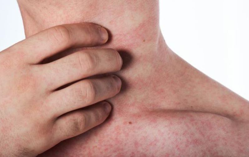  Cách phòng bệnh sốt xuất huyết