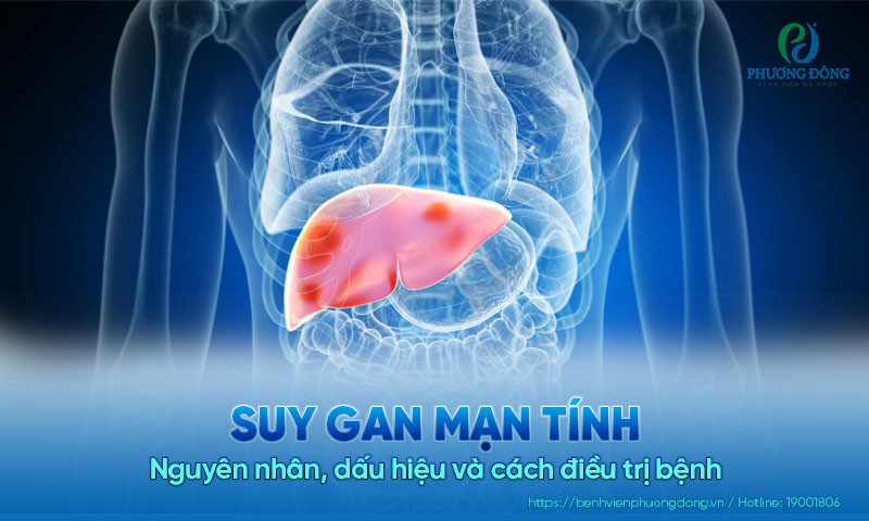 Suy gan mạn tính: Nguyên nhân, dấu hiệu và cách điều trị