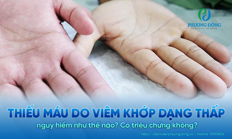 Thiếu máu do viêm khớp dạng thấp nguy hiểm như thế nào? Có triệu chứng không?