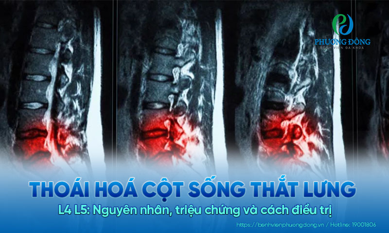 Thoái hoá cột sống thắt lưng L4 L5: Nguyên nhân, triệu chứng và cách điều trị