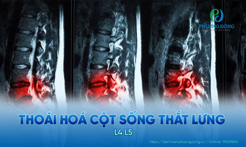 Cột sống đốt L4 L5 có thể bị thoái hoá