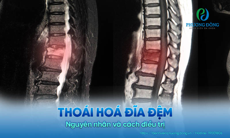 Thoái hoá đĩa đệm: Nguyên nhân và cách điều trị