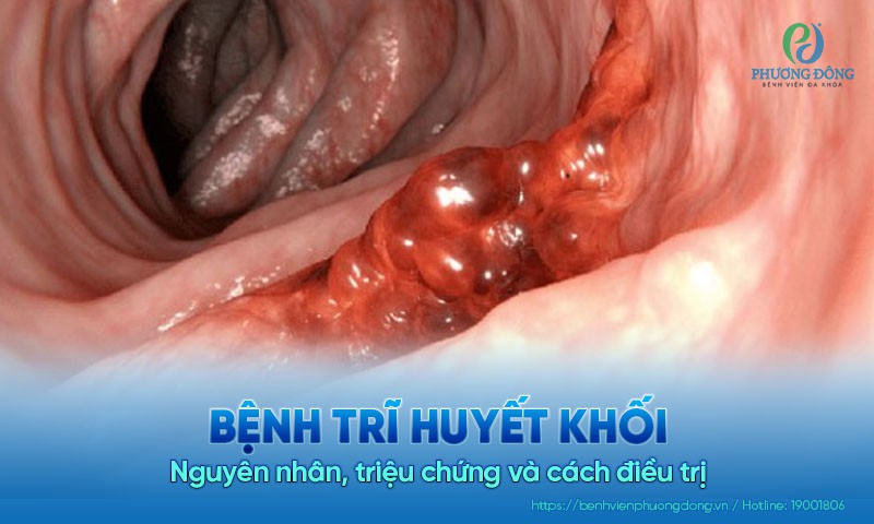 Bệnh trĩ huyết khối: Nguyên nhân, triệu chứng và cách điều trị