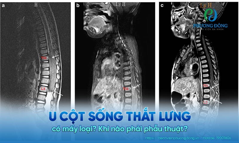 U cột sống thắt lưng có mấy loại? Khi nào phải phẫu thuật?