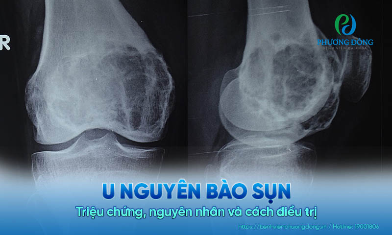 U nguyên bào sụn: Triệu chứng, nguyên nhân và cách điều trị