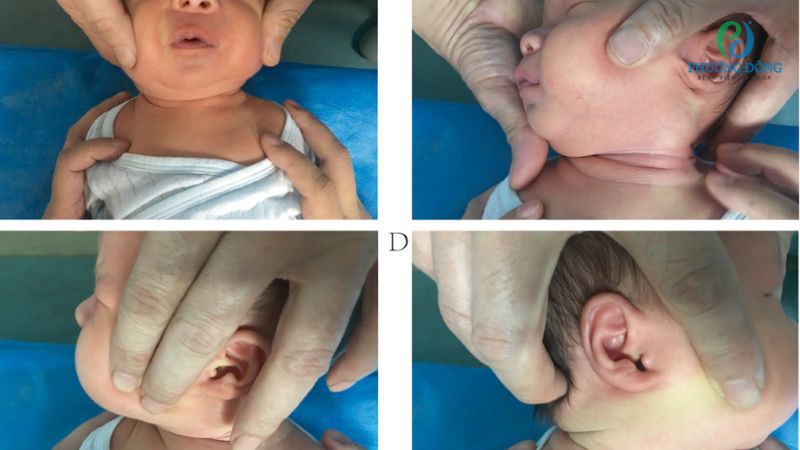 Các phương pháp phục hồi chức năng với trẻ nhỏ bị xơ hoa cơ ức đòn chũm