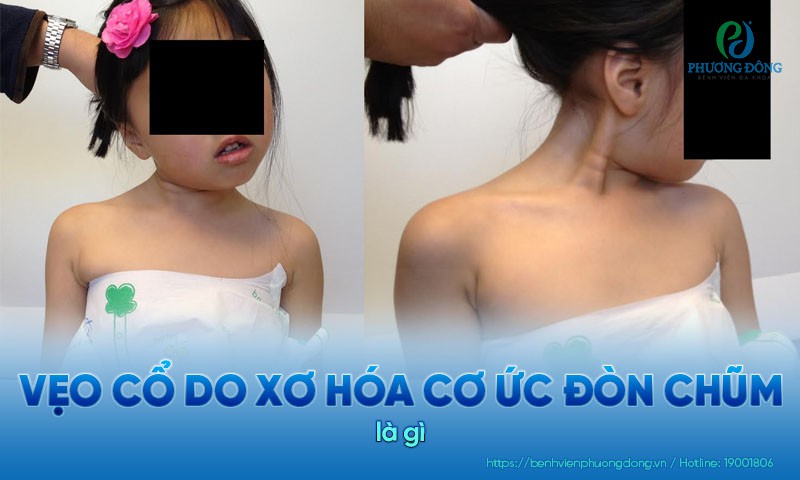 Vẹo cổ do xơ hóa cơ ức đòn chũm ở trẻ nhỏ. Dấu hiệu và điều trị