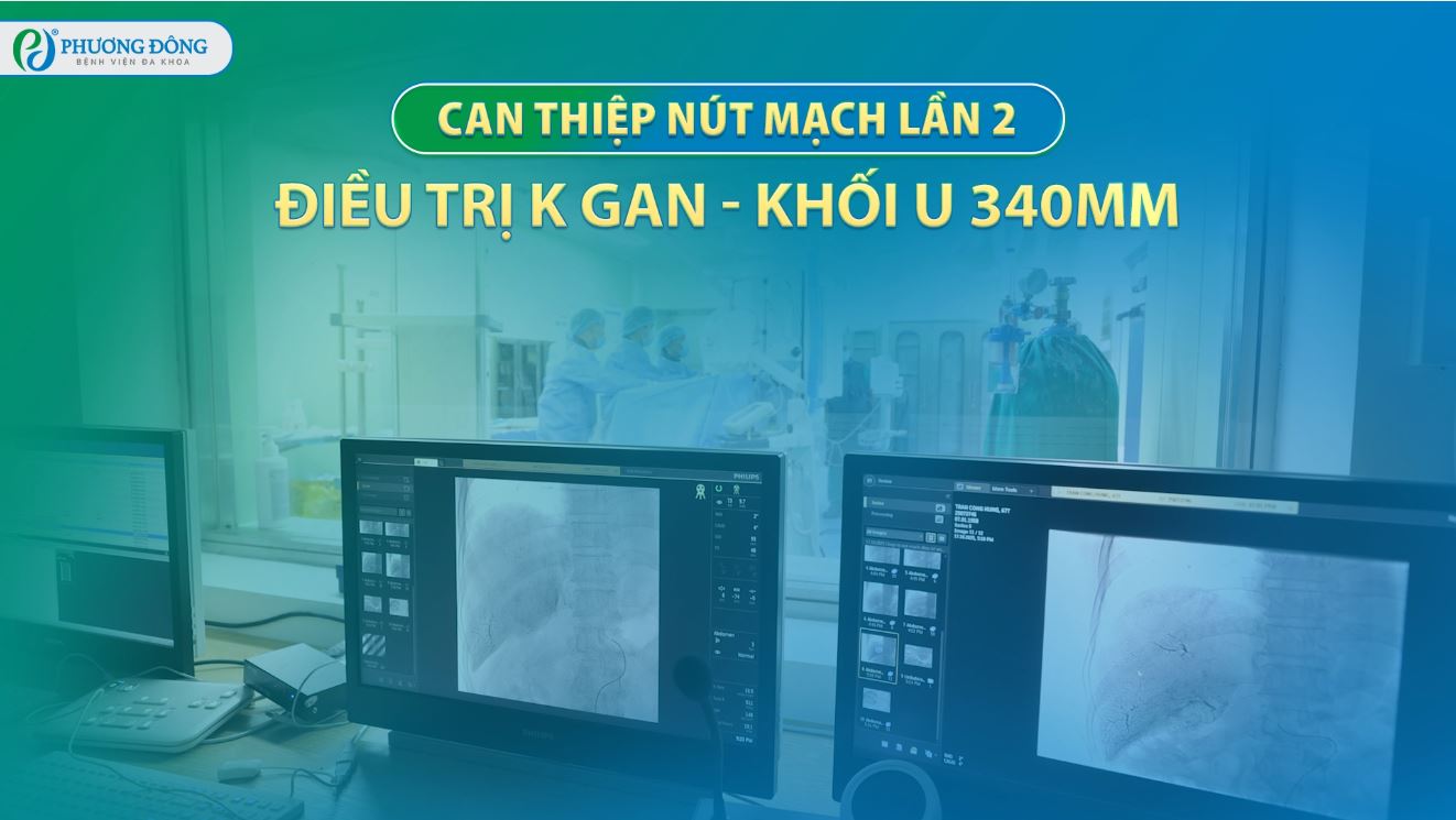 Can thiệp nút mạch lần 2: Điều trị K gan - Khối u 340 mm