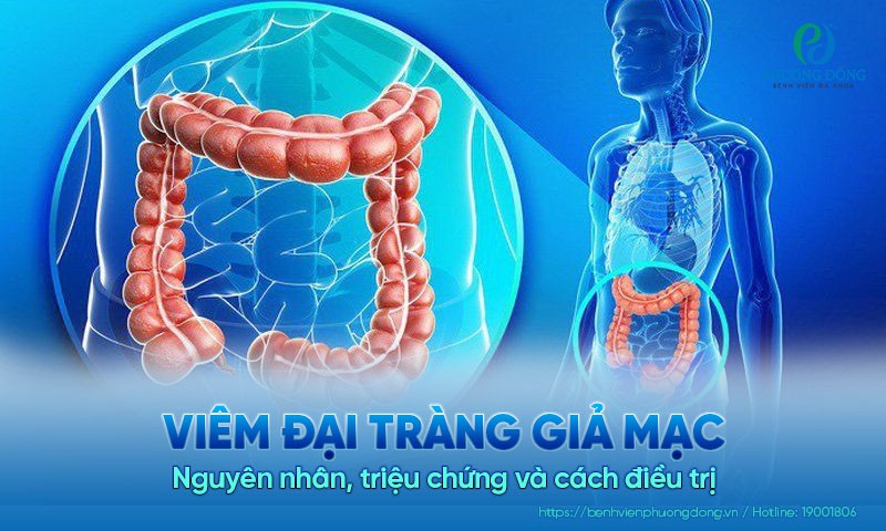 Viêm đại tràng giả mạc: Nguyên nhân, triệu chứng và cách điều trị