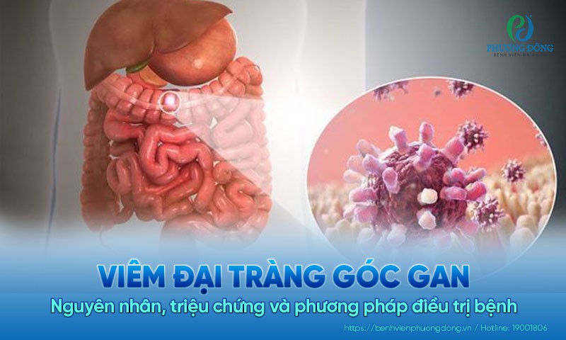 Viêm đại tràng góc gan: Nguyên nhân, triệu chứng và phương pháp điều trị bệnh