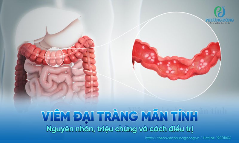 Viêm đại tràng mãn tính: Nguyên nhân, triệu chứng và cách điều trị bệnh
