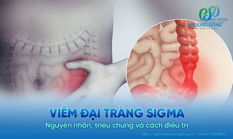 Viêm đại tràng sigma: Nguyên nhân, triệu chứng và cách điều trị