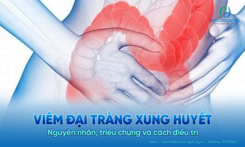 Viêm đại tràng xung huyết: Nguyên nhân, triệu chứng và cách điều trị
