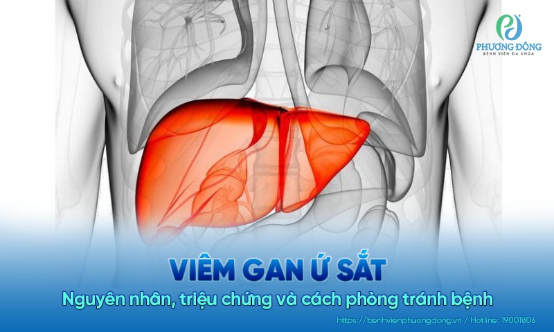 Viêm gan ứ sắt: Nguyên nhân, triệu chứng và cách phòng tránh bệnh