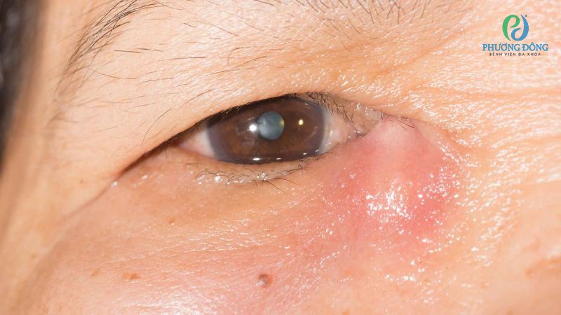 Tắc tuyến lệ làm ứ đọng nước mắt, gây tình trạng kích ứng khó chịu