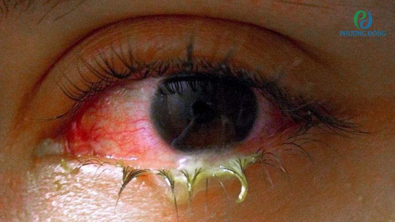 Kết mạc nhiễm khuẩn khiến mắt chảy dịch màu vàng và xanh