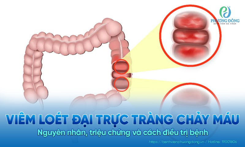 Viêm loét đại trực tràng chảy máu: Nguyên nhân, triệu chứng và cách điều trị bệnh