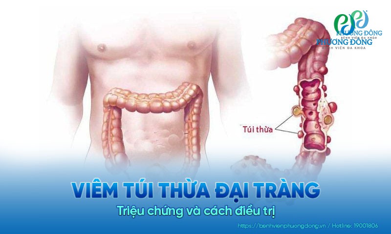 Viêm túi thừa đại tràng: Triệu chứng và cách điều trị