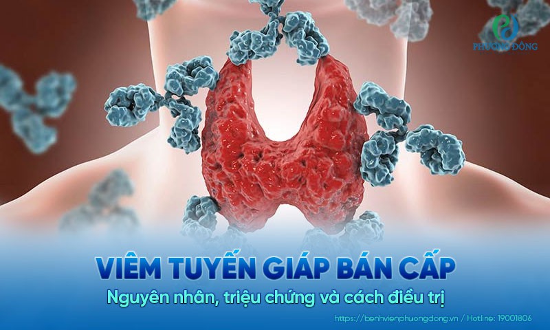 Viêm tuyến giáp bán cấp: Nguyên nhân, triệu chứng và cách điều trị 