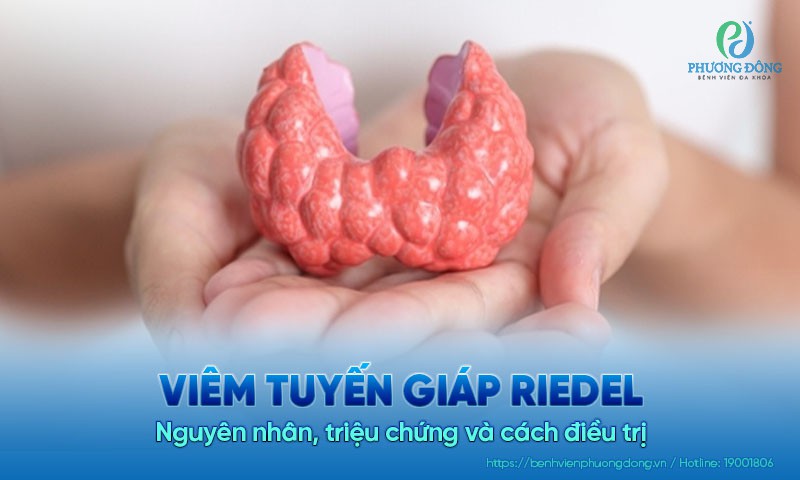 Viêm tuyến giáp Riedel: Nguyên nhân, triệu chứng và cách điều trị bệnh