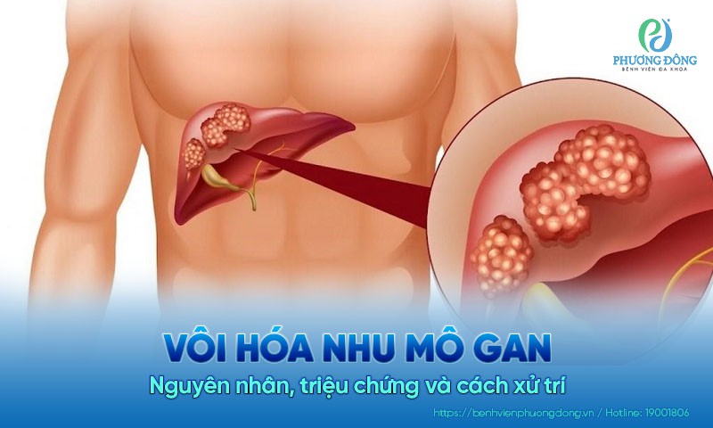 Vôi hóa nhu mô gan: Nguyên nhân, triệu chứng và cách xử trí