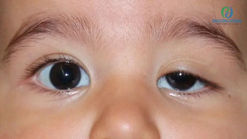 Bệnh nhi có hai mắt không cân xứng thường liên quan đến yếu tố bẩm sinh