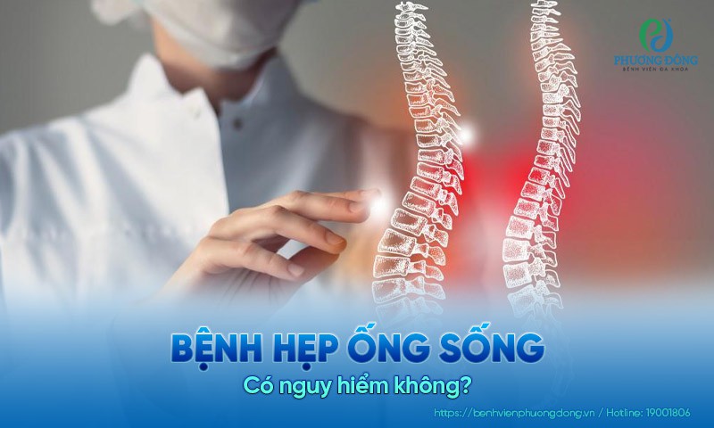 Bệnh hẹp ống sống có nguy hiểm không?