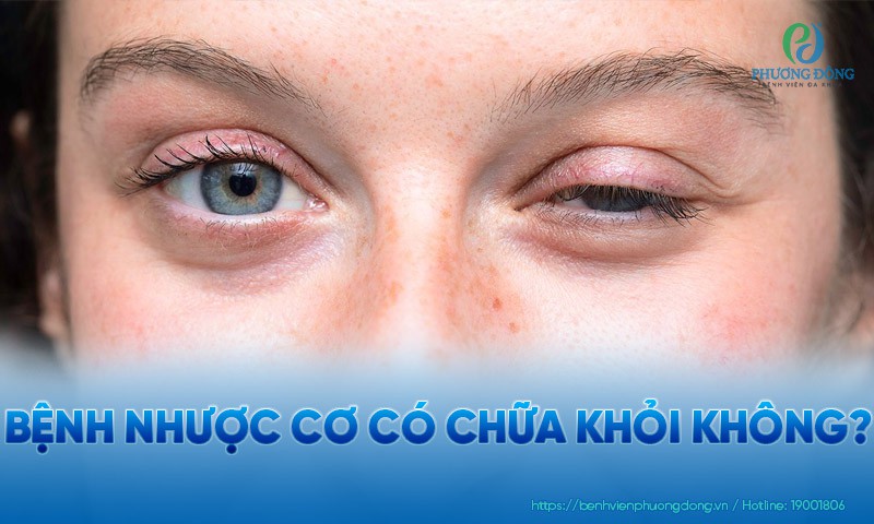 Bệnh nhược cơ có chữa khỏi không?