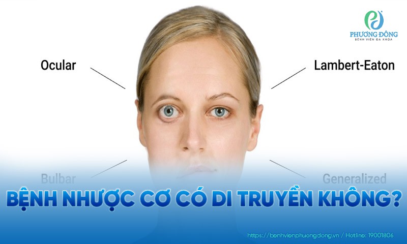 Bệnh nhược cơ có di truyền không?