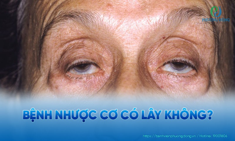 Bệnh nhược cơ có lây không?