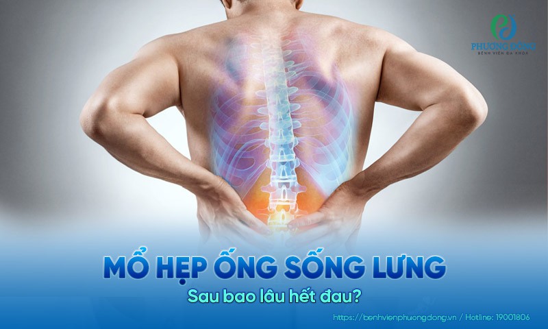 Mổ hẹp ống sống lưng sau bao lâu hết đau?