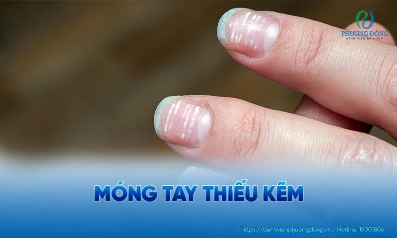 Móng tay thiếu kẽm