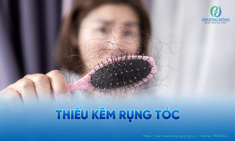 Thiếu kẽm rụng tóc