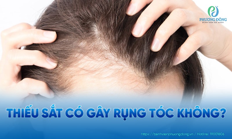 Thiếu sắt có gây rụng tóc không?