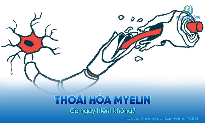 Thoái hóa myelin có nguy hiểm không?